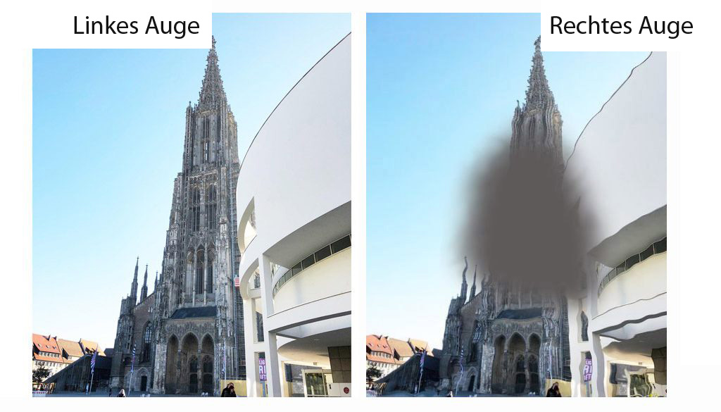 Makuladegeneration, Augenarzt Ulm