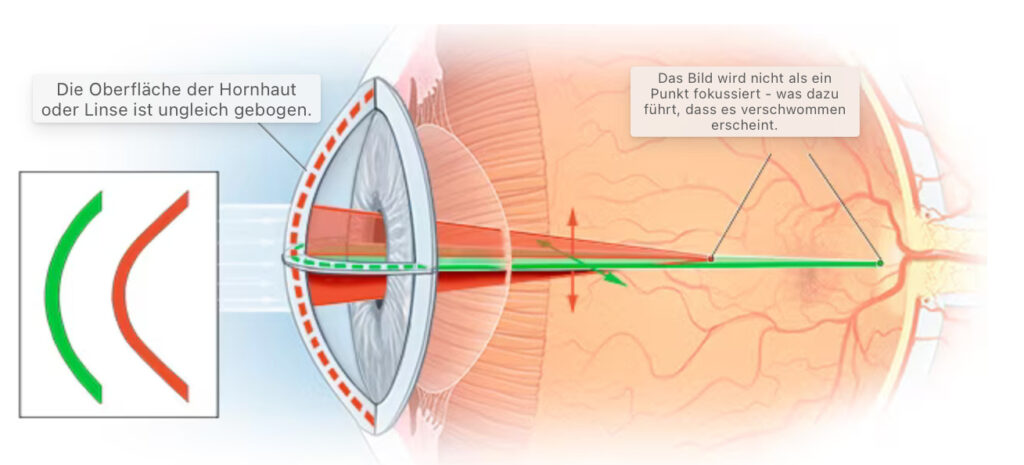 Hornhautverkrümmung am Schaubild