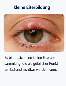 Symptome eines Gerstenkorns - kleine Eiterbildung