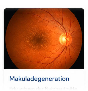 Makuladegeneration