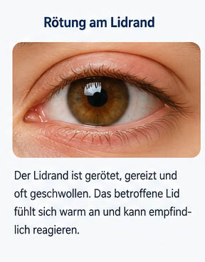 Symptome eines Gerstenkorns - Rötung am Lidrand